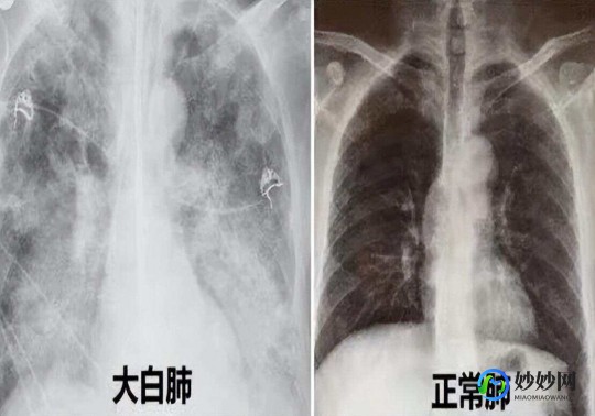 白肺可以恢复正常吗,白肺能恢复成正常肺吗