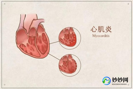 心肌炎症状及表现,心肌炎症状及表现