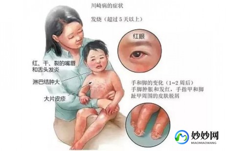 丙种球蛋白的功效与作用,丙球蛋白的作用功效是什么