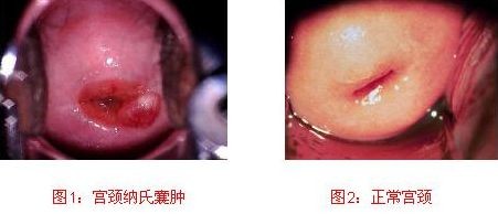 宫颈纳囊是什么,什么是宫颈纳囊