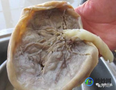 吃胎盘,胎盘是什么东西,可以吃吗