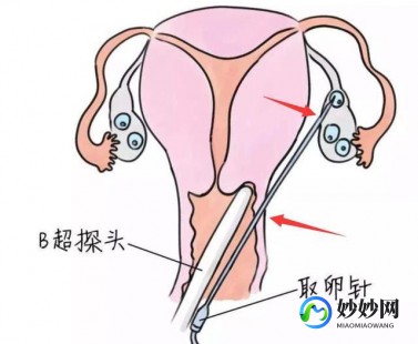 取卵针,试管取卵针为啥要选长度和粗细？影响采卵效果是关键