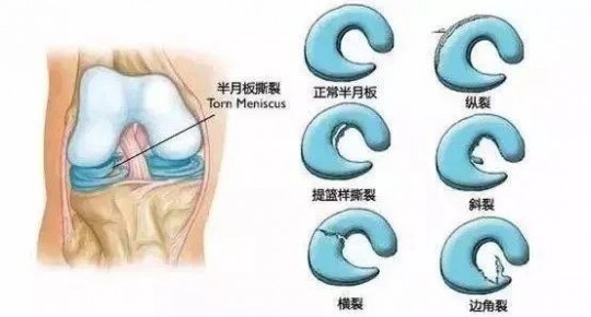半月板损伤分级,半月板损伤分几度