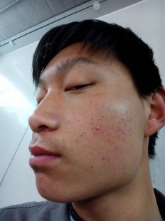 有效去除痤疮,脸上长痤疮怎么才能消除掉