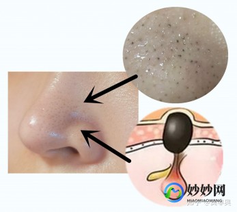 怎么有效去黑头,十个最有效的去黑头方法