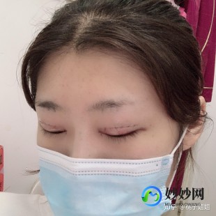 眼综合手术包括什么项目,眼综合手术包括什么项目？