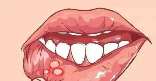 口腔溃疡是缺维生素吗,口腔溃疡是缺什么维生素
