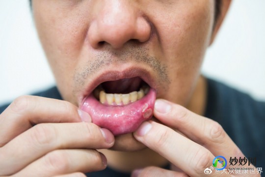 口腔溃疡是缺维生素吗,口腔溃疡是缺什么维生素