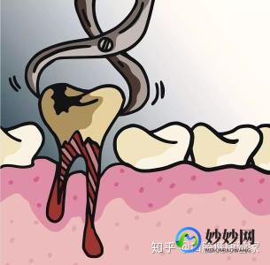 拔牙之后需要注意什么事项,拔牙之后需要注意什么事项