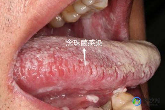 口腔念珠菌感染,口腔白色念珠菌感染症状