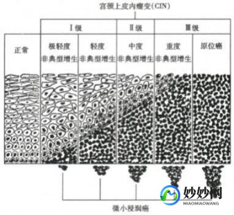 低度cin病变,低度cin病变是什么意思