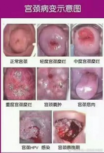 宫颈ca能活多久,宫颈ca能活多久