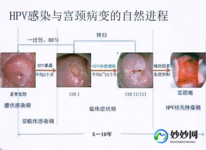 宫颈ca能活多久,宫颈ca能活多久