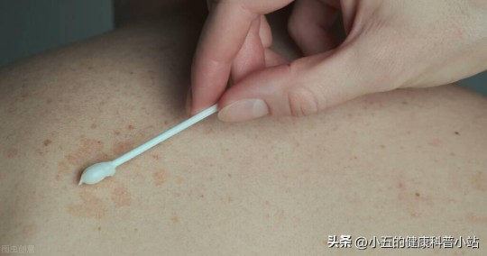 多磺酸粘多糖乳膏,多磺酸粘多糖乳膏可以长期涂脸上吗