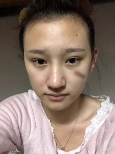 多磺酸粘多糖乳膏,多磺酸粘多糖乳膏可以长期涂脸上吗