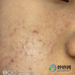两边脸颊长痘痘,脸颊两侧长硬硬的痘痘