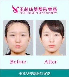 打瘦脸针会反弹吗,瘦脸针反弹吗