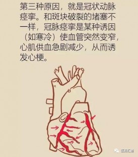 心肌梗塞原因,引发心肌梗塞的诱因主要有哪些