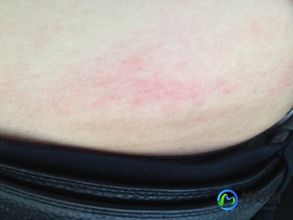 大腿内侧与阴囊两侧瘙痒潮湿,大腿阴囊两侧很痒