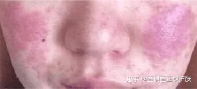 红血丝怎么去除,红血丝如何祛除