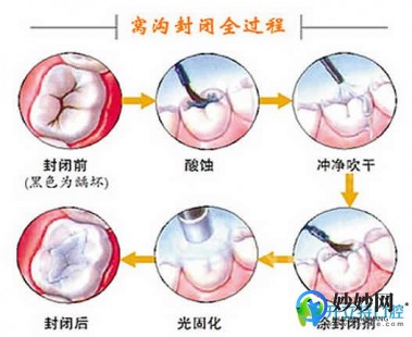 窝沟封闭步骤,窝沟封闭步骤是什么