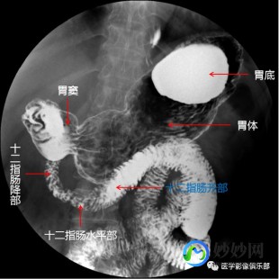 全消化道造影,消化道造影检查是怎么做的