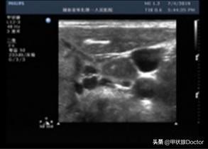甲状腺四级,甲状腺结节4级是什么意思