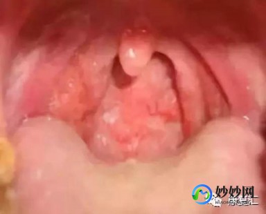 女子阳性高烧后舌头长满厚白舌苔,发烧三天整个舌苔全白了怎么回事,怎么办