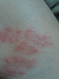 大腿内侧与阴囊两侧瘙痒潮湿,大腿内侧阴囊附近很痒怎么办
