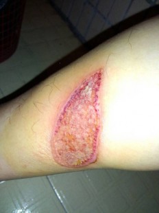 大腿内侧与阴囊两侧瘙痒潮湿,大腿内侧阴囊附近很痒怎么办
