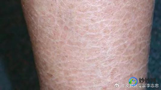 盛生网,盛生网-手足皲裂 鱼鳞病