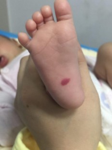 祛除胎记,怎么除胎记