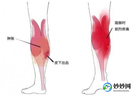 小腿拉伤,小腿肌肉拉伤怎么办恢复快点