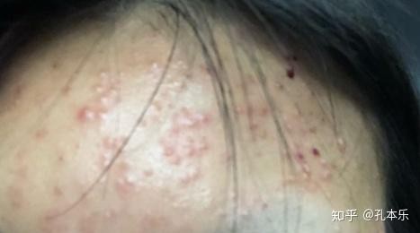 毛囊炎用什么药最有效,毛囊炎用什么药治疗效果最好