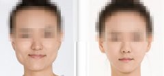 下颌手术大概需要多少钱,下颌手术大概需要多少钱