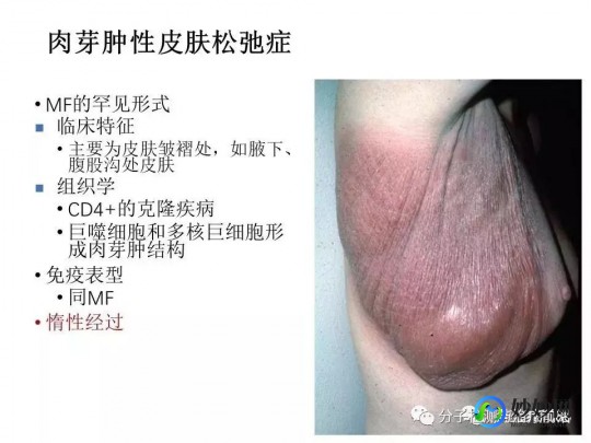 t型淋巴瘤,T型皮肤淋巴瘤怎么回事,怎么办
