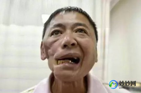 嚼槟榔,经常嚼槟榔有哪些危害