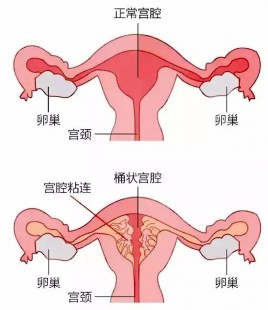 宫颈粘连,宫颈粘连能治好吗