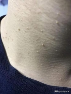 hpv怎么引起的,HPV感染的主要原因