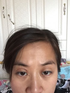 眼皮子薄,眼皮太薄怎么办