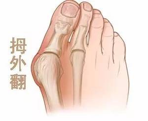 大脚趾骨头痛,脚大拇趾骨头疼怎么回事怎么办