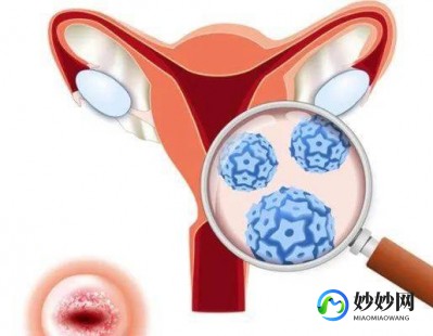 宫颈癌最准确的征兆,宫颈癌有什么症状和现象