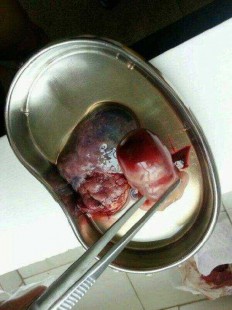 打胎有什么危害,打胎的危害