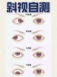 假性斜视,怎样分辨真斜视和假斜视