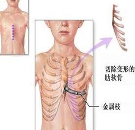 漏斗胸,小儿漏斗胸