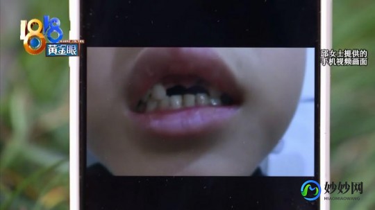 门牙断了,门牙摔断了,该怎么处理才好