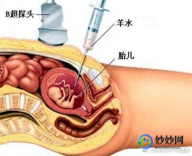 什么是羊水穿刺,羊水穿刺是什么意思