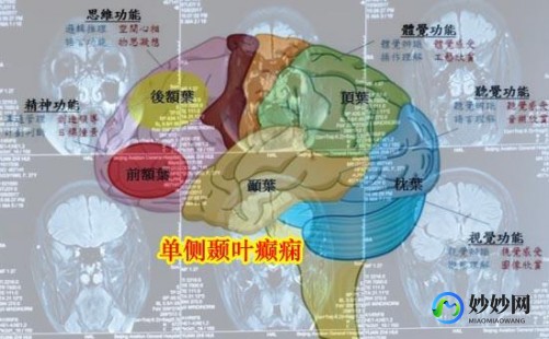颞叶癫痫,什么是颞叶癫痫