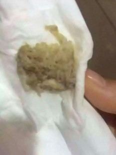 人流后出血,人流后鲜红色的血怎么回事