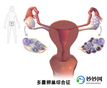 多囊卵巢症,多囊卵巢综合症症状有哪些